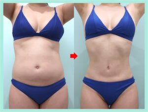 腹部・腰脂肪吸引後のビフォーアフター(正面)