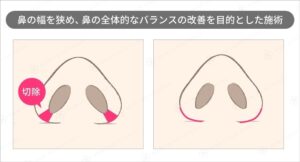 小鼻縮小の切除範囲と術後のイラスト