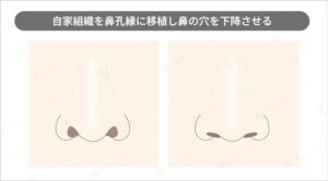 鼻孔縁下降の術前と術後の比較