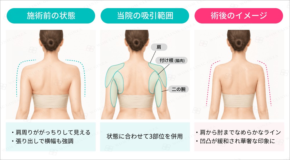 二の腕脂肪吸引の施術前と術後のイメージイラスト