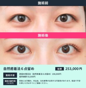 自然癒着法6点留めの症例