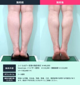 ボディ脂肪吸引のビフォーアフター01