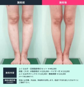 ボディ脂肪吸引のビフォーアフター02