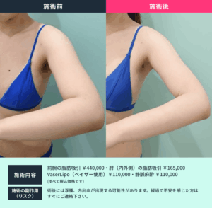 ボディ脂肪吸引のビフォーアフター03