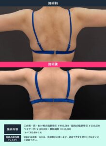 ボディ脂肪吸引のビフォーアフター04