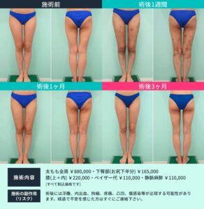 ボディ脂肪吸引のビフォーアフター05