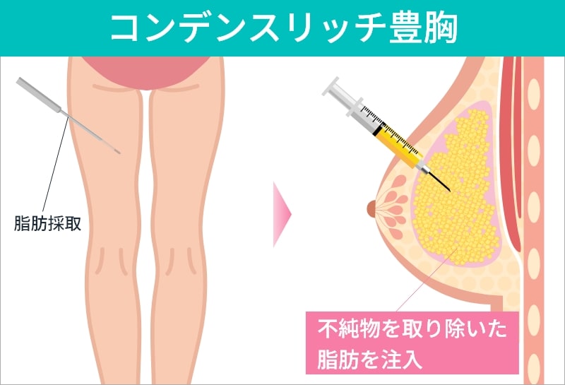 コンデンスリッチ豊胸
