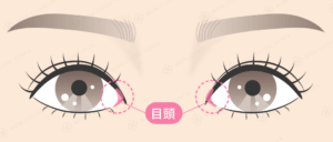 目頭切開と目尻のイラスト