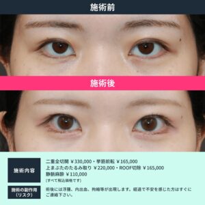 二重整形の症例03