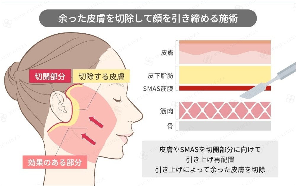 フェイスリフト（顔の若返り手術）