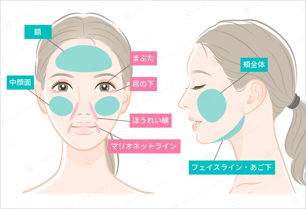 顔のたるみ治療部位