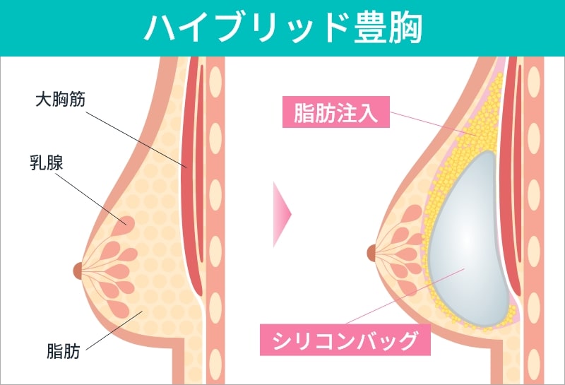 ハイブリッド豊胸