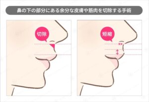 人中短縮術の術前と術後の比較図