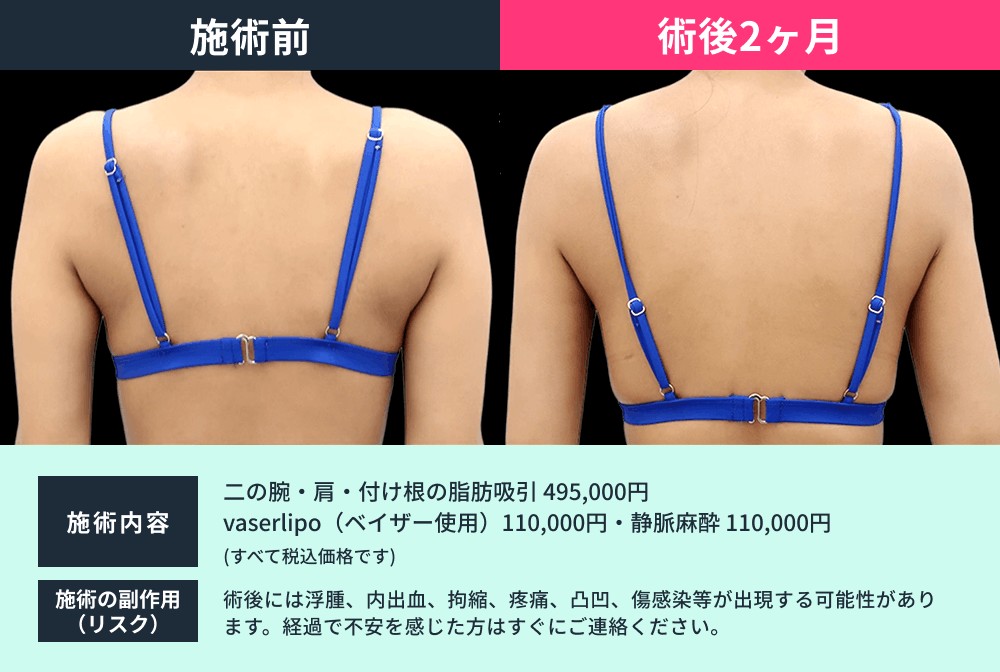 二の腕脂肪吸引の症例03