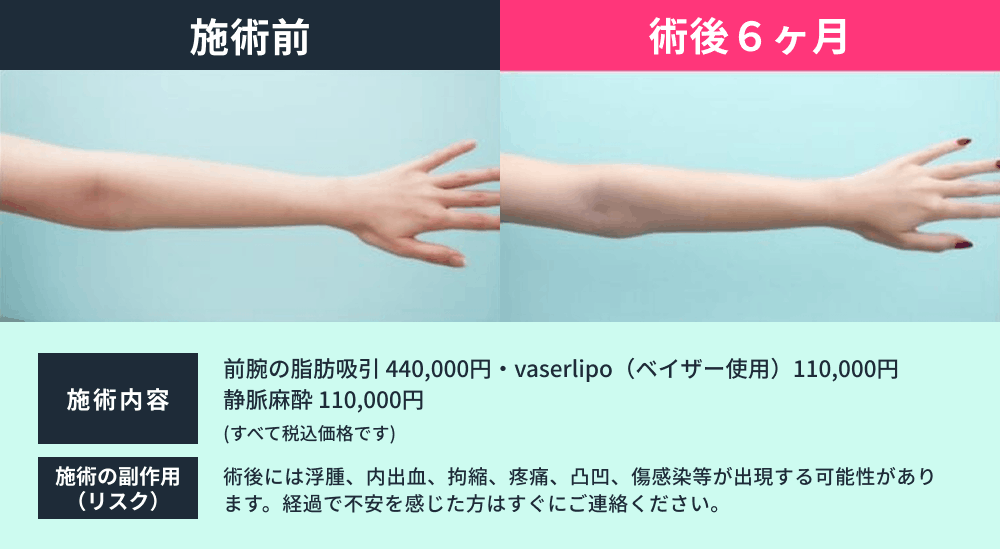 前腕脂肪吸引の症例