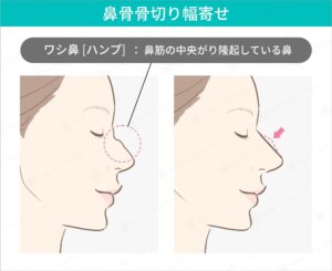 鼻骨骨切り幅寄せの術前術後の比較図