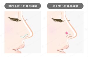 鼻尖形成術の整形のビフォーアフター