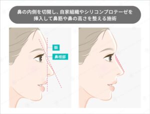 隆鼻術のビフォーアフターと横顔のライン