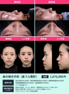 鼻整形の症例02