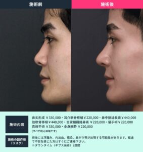 鼻整形の症例03