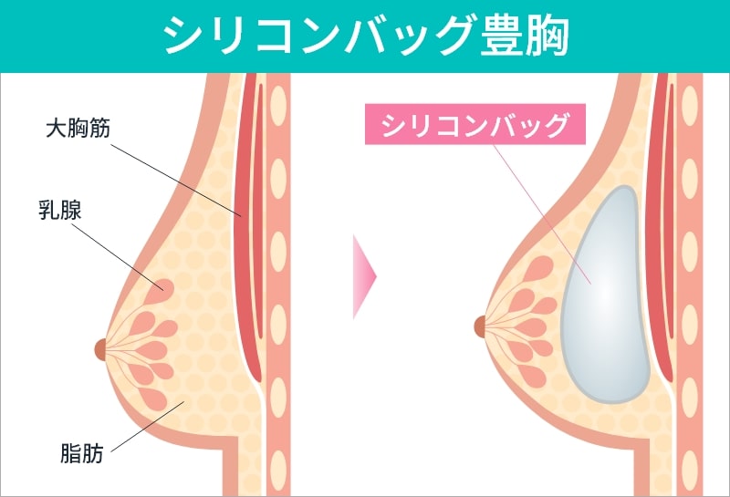 シリコンバッグ豊胸