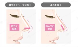 鼻尖形成術の術前と術後の比較図