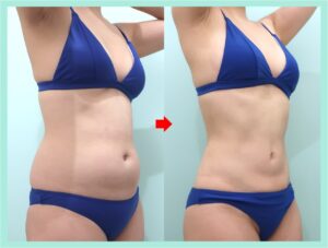 腰の脂肪吸引後のビフォーアフター(正面)
