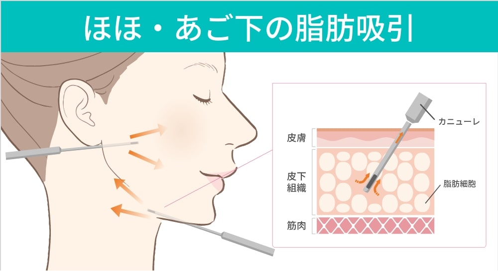 特殊なカニューレを挿入して脂肪を吸引
