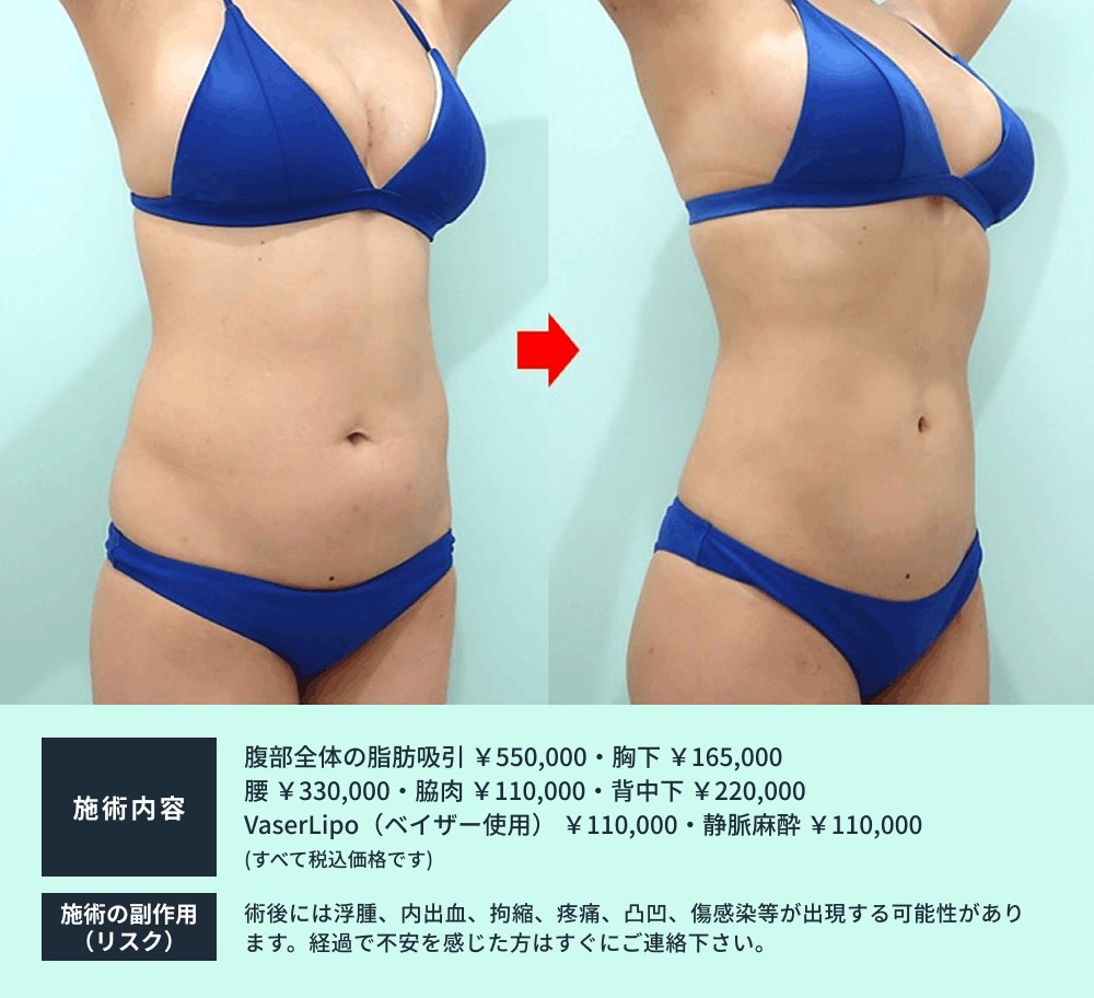 腹部脂肪吸引 1ヶ月後