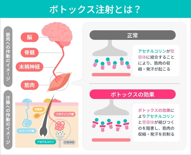 ボトックス注射の仕組みを解説するイラスト