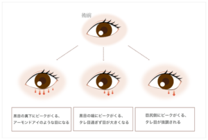 アーモンドアイ形成の種類