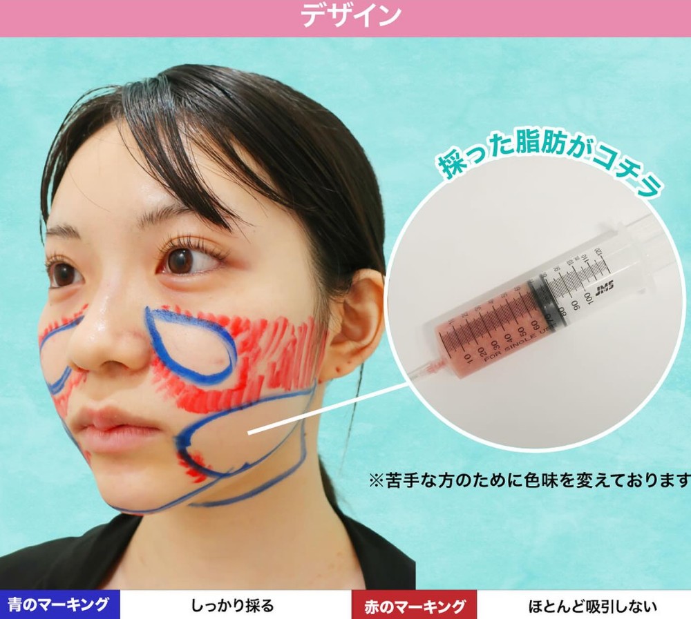 脂肪吸引のデザインと採取した脂肪