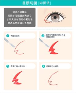 目頭切開　内田法