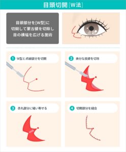 目頭切開　W法