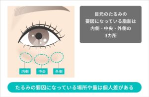 たるみの原因である3か所を除去