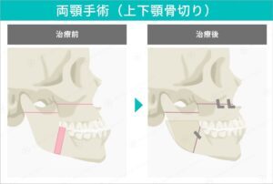 両顎手術の施術範囲