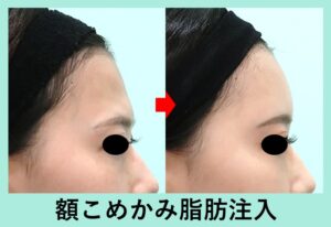 脂肪注入の症例写真