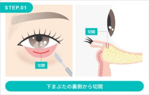 目の下の脂肪取りの施術方法　STEP.1