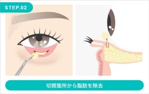 目の下の脂肪取りの施術方法　STEP.2