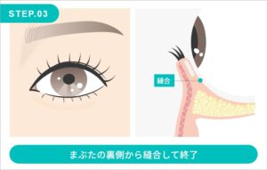 目の下の脂肪取りの施術方法　STEP.3