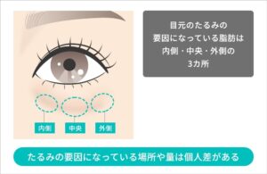 目の下の脂肪取りの施術箇所