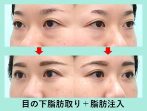 目の下脂肪取り＋目の下の脂肪注入の症例写真03