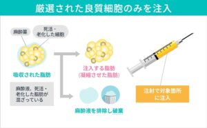 厳選された良質細胞のみを注入