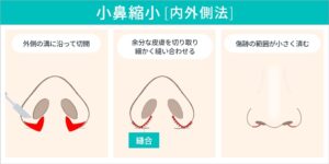 小鼻縮小（内外側法）