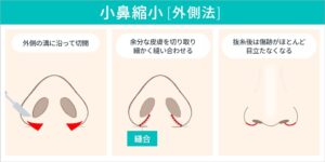 小鼻縮小（外側法）