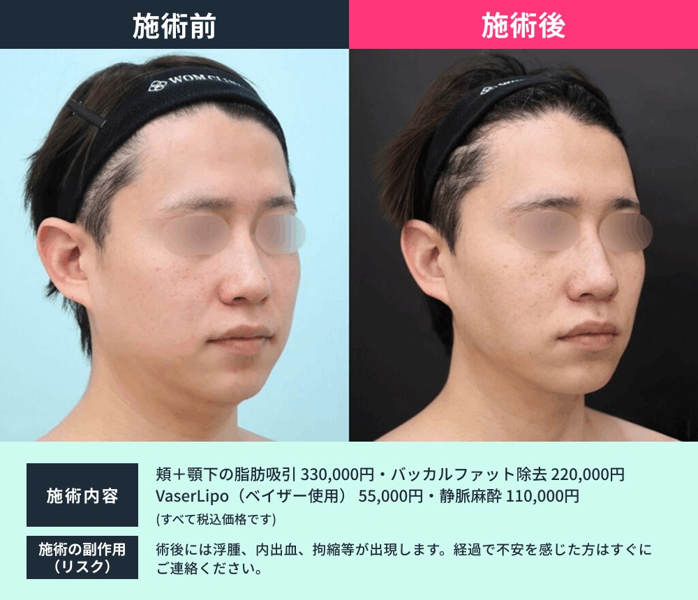 男性の顎下脂肪吸引のビフォーアフター