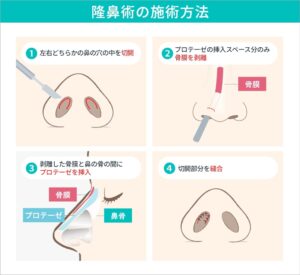 隆鼻術の施術方法