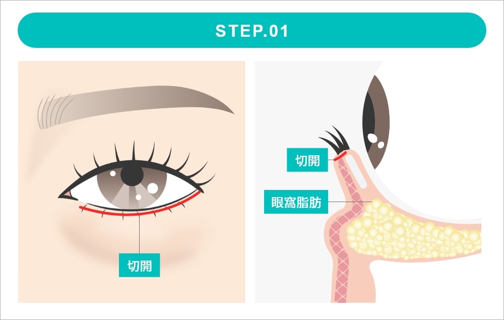 表ハムラ法の施術 STEP1