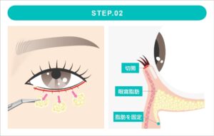 表ハムラ法の施術　STEP2