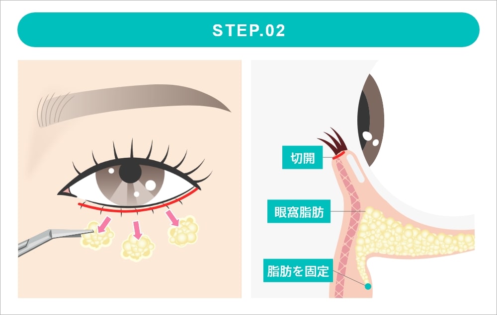表ハムラ法の施術 STEP2